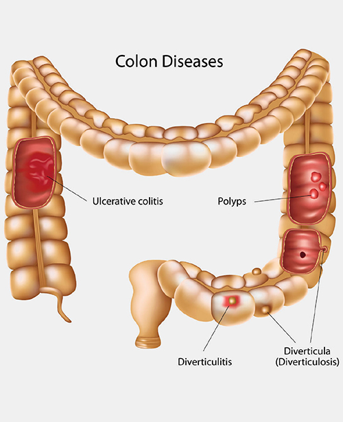 About Diverticular Disease