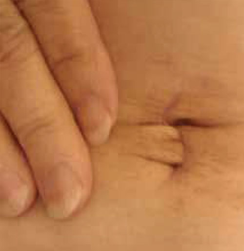 Minimally Invasive Colorectal Surgery