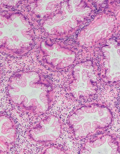 Colon Polyps
