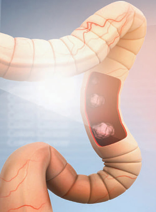 Screening for Colorectal Cancer