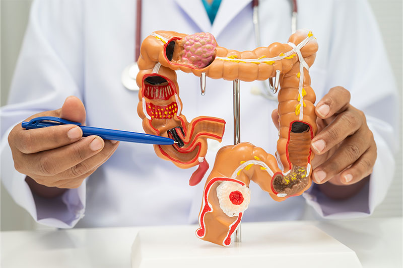 Doctor holding a medical model of the intestine and colon, illustrating colorectal cancer awareness.