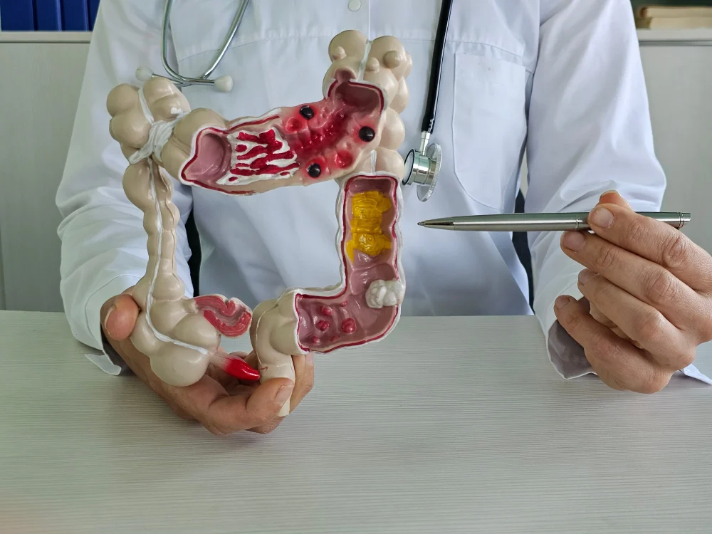 Colorectal surgeon holding a human colon anatomy model while explaining surgical treatment options.