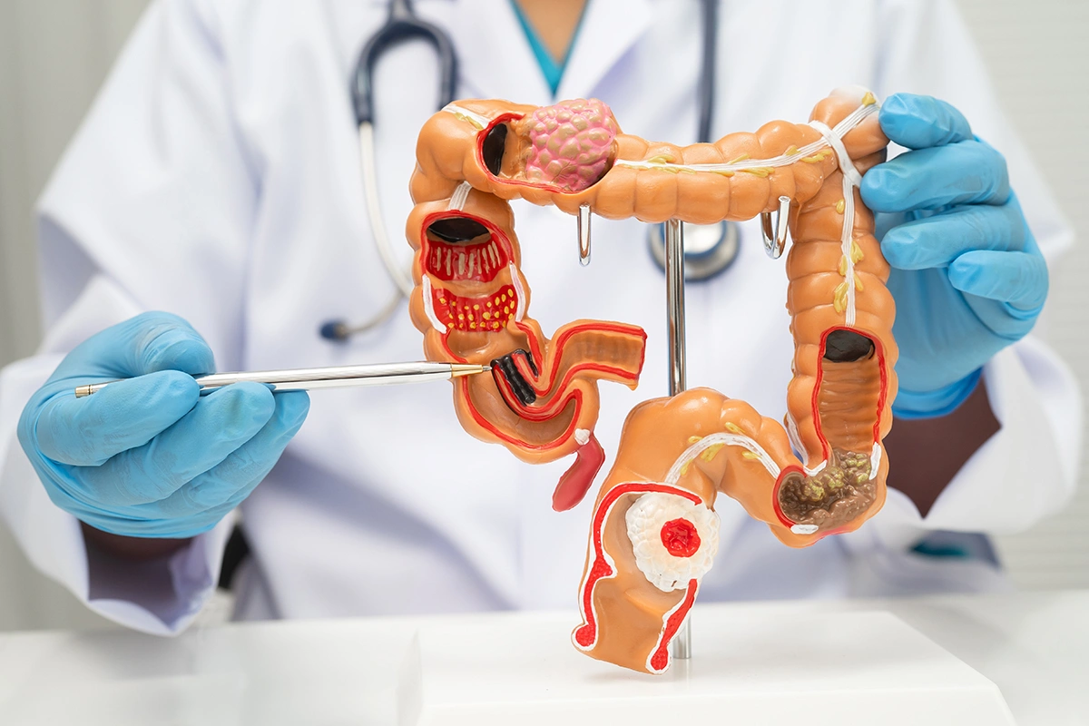 Colorectal surgeon holding a human colon anatomy model for diagnosis and treatment consultation.